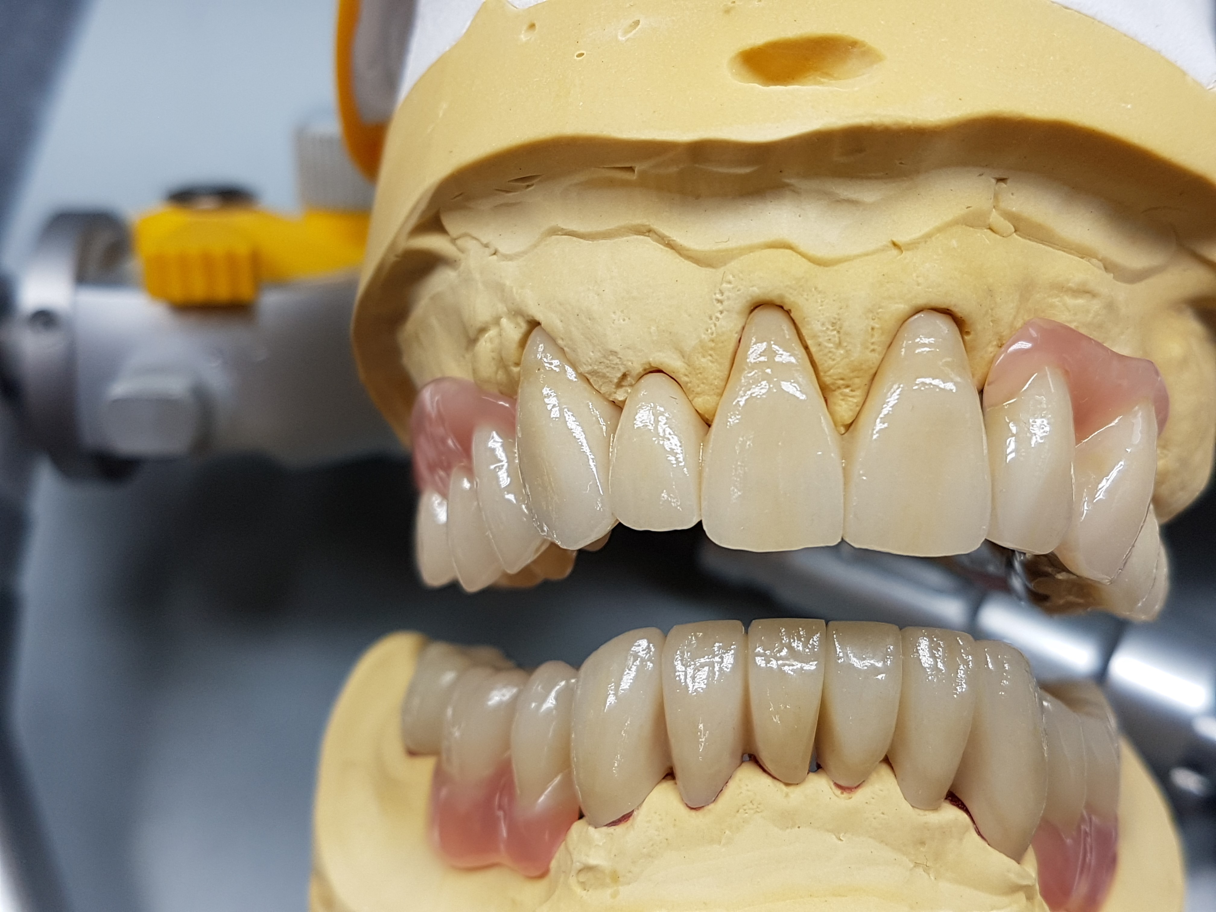 Lipp Zahntechnik Geschiebeprothetik